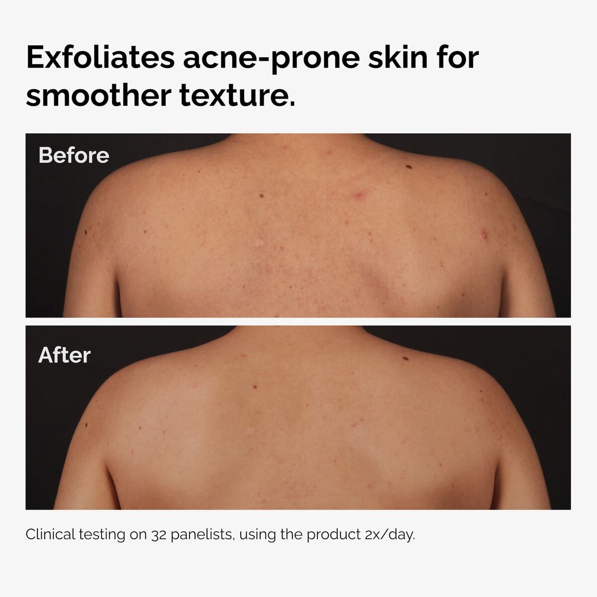 Salicylic Acid Body Serum Targeted Serum Care A6